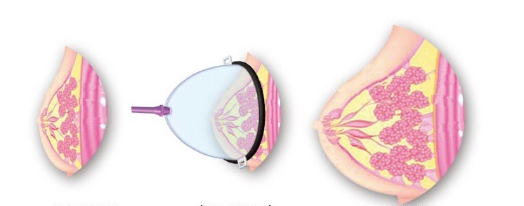 Máy massage nâng ngực hiệu quả tăng vòng 1 săn chắc