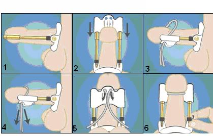 Máy kéo dài dương vật Proextender II chính hãng giá tốt Máy kéo dài dương vật Proextender II chính hãng giá tốt